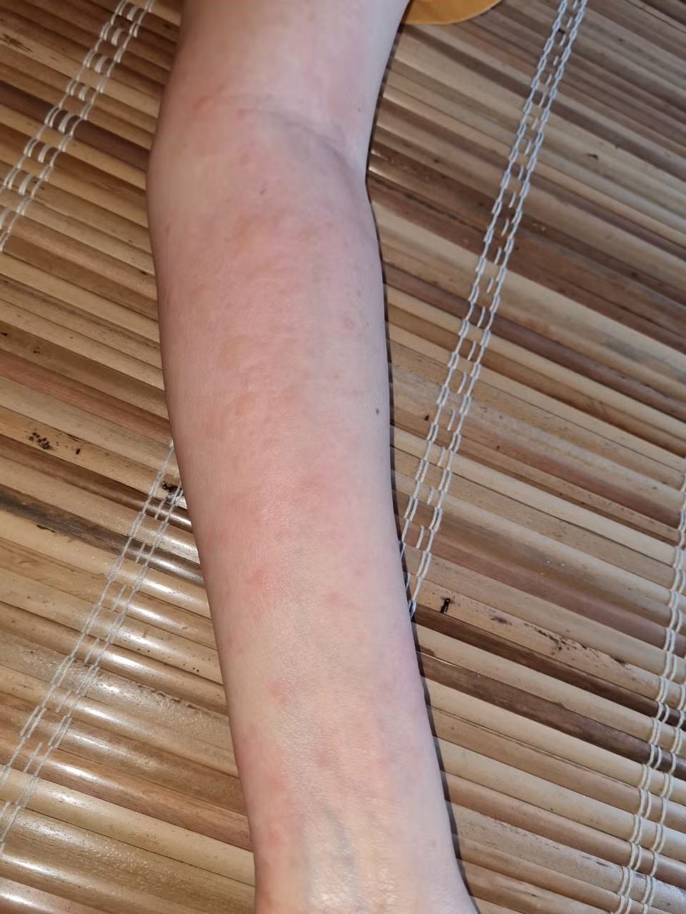 Một bệnh nhân bị sốc phản vệ sau khi bị kiến xoan đốt với các biểu hiện hạ huyết áp, vật vã, nổi mề đay toàn cơ thể, buồn nôn, đi ngoài...Trong tình huống này, cần đưa ngay bệnh nhân đi cấp cứu. Ảnh: Tri thức và Cuộc sống.