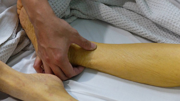 Nguyên nhân của hiện tượng này bắt nguồn từ chất có tên gọi "bilirubin". Chất thải có màu vàng sinh ra từ mật thường được xử lý tại gan. Khi có quá nhiều bilirubin trong máu, chất này có thể rò rỉ vào các mô như da - mắt, khiến chúng chuyển màu vàng. Ban đầu, bệnh nhân chỉ bị vàng ở nhãn cầu, củng mạc sau sẽ lan rộng ra toàn thân.