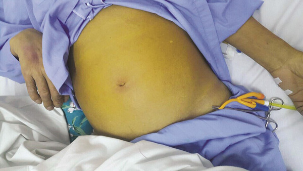 Da bụng vàng. Mắc các bệnh như ung thư gan, ung thư tuyến tụy, ung thư đường mật có thể khiến da bụng chuyển màu vàng.