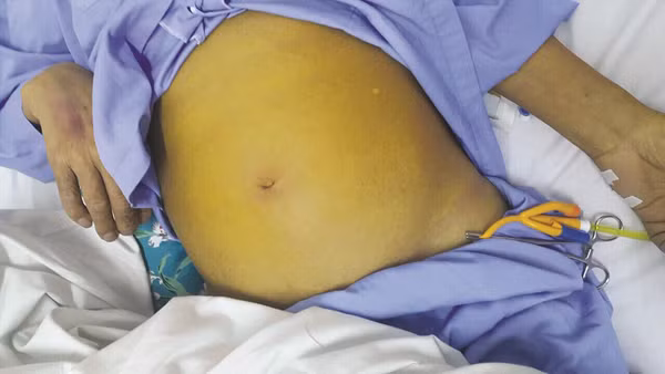 Da bụng vàng. Mắc các bệnh như ung thư gan, ung thư tuyến tụy, ung thư đường mật có thể khiến da bụng chuyển màu vàng.