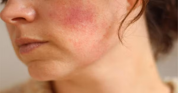 Kích ứng da. Lớp màng nilon bảo vệ đệm khỏi bụi bẩn. Đồng thời, nó cũng khiến độ ẩm bên trong đệm khó có thể thoát ra ngoài. Theo thời gian, đệm sẽ là môi trường lý tưởng để các loại vi khuẩn, nấm mốc sinh sôi, ảnh hưởng đến sức khỏe người dùng.