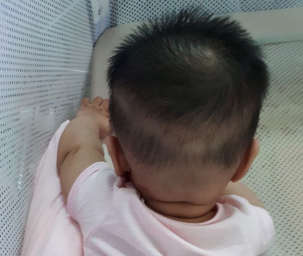 Thay đổi vùng da, màng nhầy. Trẻ thiếu kẽm dễ tái phát tình trạng loét vùng miệng lưỡi, viêm da, mụn bọc, mụn mủ, rụng tóc... Nó cũng khiến trẻ dễ bị viêm đường tiêu hóa, tiêu chảy kéo dài.