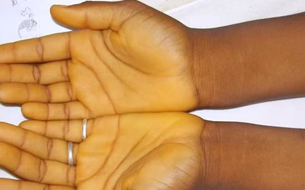 Gan là cơ quan chuyển hóa bilirubin. Khi gan bị tổn thương, nó sẽ gây rối loạn chuyển hóa bilirubin, làm tăng nồng độ bilirubin trong cơ thể dẫn đến hiện tượng vàng da.