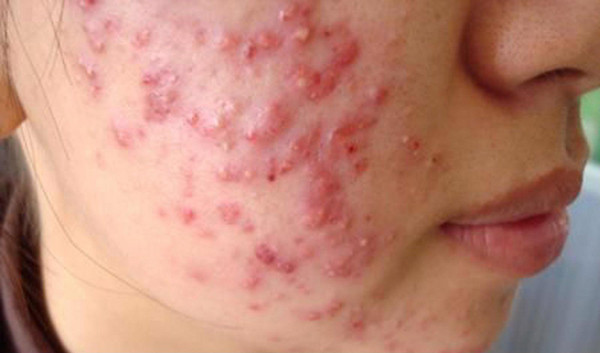 Tuy nhiên, nếu mặt bỗng dưng nổi mụn nhiều bất thường cho thấy gan có vấn đề. Rất có thể, quá trình trao đổi chất suy giảm, chất độc và bài tiết không thải ra ngoài được nên mặt thường xuyên nổi mụn.
