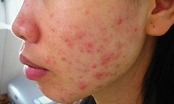 Ngược lại, người có gan tốt, chức năng chuyển hóa và giải độc trong cơ thể vẫn bình thường sẽ rất ít mụn trên mặt.