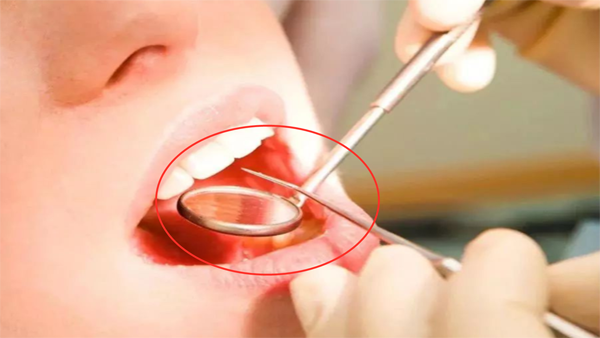 Sau khi kiểm tra phim chụp răng, bác sĩ tiến hành nhổ. Vậy nhưng, thời điểm nhổ răng, máu chân răng bệnh nhân liên tục chảy, không thể cầm được.