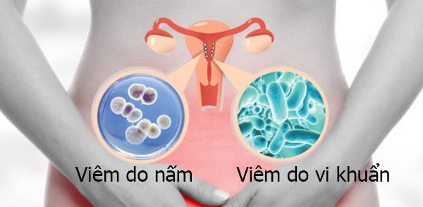 Nguyên nhân bởi có nhiều vi khuẩn trú ngụ trong âm đạo. Sự tồn tại của chúng giúp ổn định môi trường âm đạo, giúp âm đạo thực hiện chức năng tự thanh lọc. Thụt rửa âm đạo nhiều lần sẽ phá vỡ cân bằng vi khuẩn trong âm đạo, gây bất lợi cho sức khỏe vùng kín. Ảnh: Internet