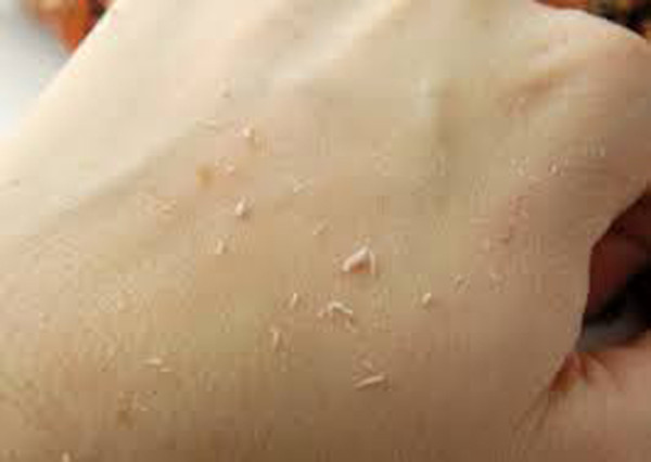 Kì mạnh ghét trên da. Ghét trên da hình thành từ những mảng vụn da chết, bụi bẩn hoặc mồ hôi. Để cơ thể sạch sẽ, tắm rửa hàng ngày rất cần thiết.