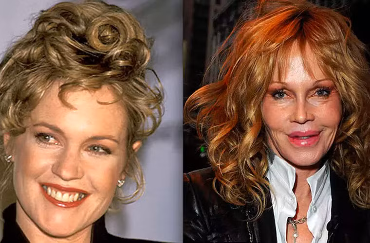  Melanie Griffith đã bị biến dạng vì nghiện phẫu thuật thẩm mỹ. Bà đã không còn giữ được nét xinh đẹp duyên dáng trước kia nữa vì chỉnh sửa quá nhiều. (Ảnh: plasticsurgerys)