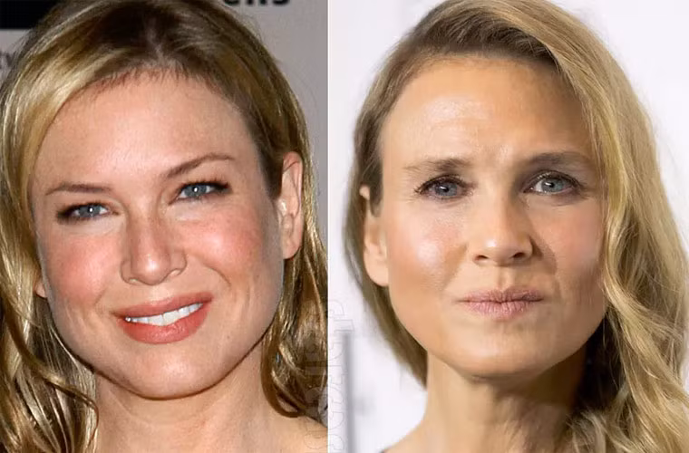 Kể từ năm 2010, Renee Zellweger ít diễn hơn và cũng từ đó ngôi sao Hollywood thay đổi diện mạo chóng mặt. Năm 2014 khi xuất hiện trên thảm đỏ một sự kiện, ngôi sao "Nhật ký tiểu thư Jones" đã khiến mọi người ngạc nhiên với khuôn mặt sưng phồng, khác hẳn trước kia. Từ đó, Renee Zellweger luôn bị “soi” vì thay đổi vẻ ngoài. (Ảnh: starcasm.net)