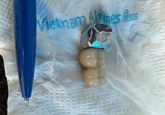 Nuot cau rang gia khi an pho, di vat the nao nguy hiem?