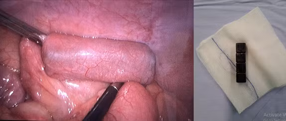 Be trai 7 tuoi gap nguy hiem khi nuot 4 cuc nam cham