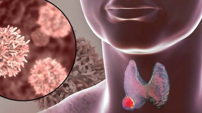 Roi loan giac ngu coi chung benh ly tuyen giap