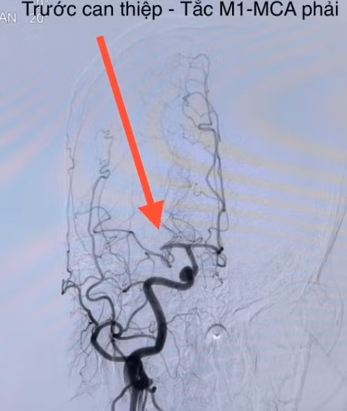 Nhan biet som dau hieu dot quy nao tranh bien chung nguy hiem