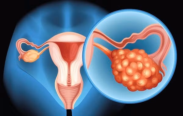 Nhan biet dau hieu cua u buong trung xoan can den vien gap-Hinh-2