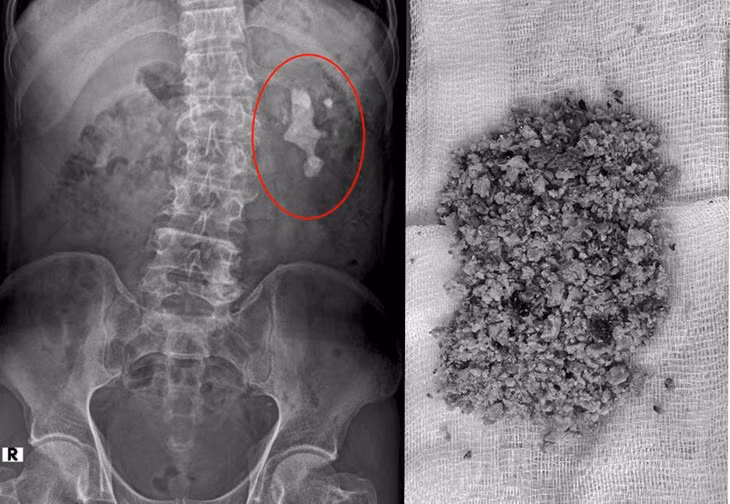 Thói quen thường ngày là “hung thủ” gây sỏi thận, nhiều người mắc Thoi quen thuong ngay la “hung thu” gay soi than, nhieu nguoi mac