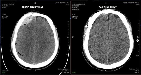 Tai tao guong mat cho benh nhan da chan thuong sau tai nan-Hinh-3