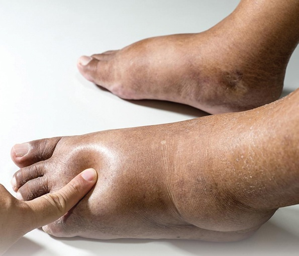 Bac si chi ro dau hieu nhan biet suy tim cap-Hinh-3