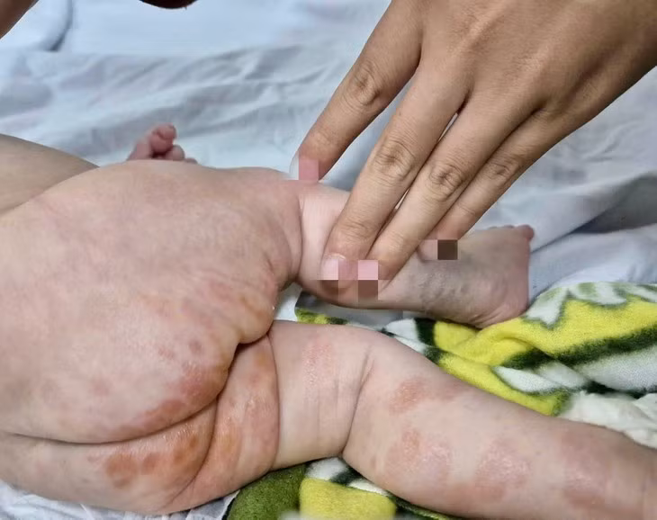 Be trai loet khap nguoi vi mac giang mai bam sinh