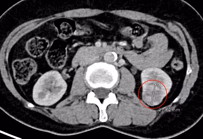 Khám tăng huyết áp định kỳ, bất ngờ phát hiện ung thư thận Kham tang huyet ap dinh ky, bat ngo phat hien ung thu than
