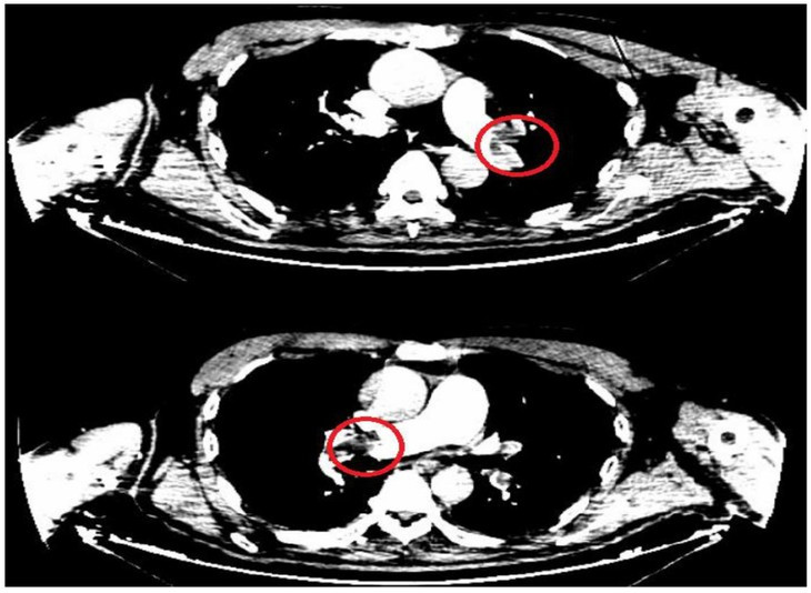 Thuyen tac dong mach phoi dieu tri dung de thoat “an tu”-Hinh-2