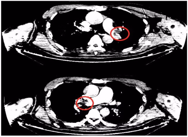 Thuyen tac dong mach phoi dieu tri dung de thoat “an tu”-Hinh-2