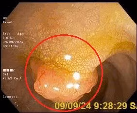 Người phụ nữ 34 tuổi cùng lúc mắc hai bệnh ung thư - Hình 2 Nguoi phu nu 34 tuoi cung luc mac hai benh ung thu-Hinh-2