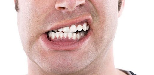  Nghiến răng: Việc nghiến răng liên tục có thể khiến cho cấu trúc khuôn mặt bạn bị biến đổi. Nghiến răng nhiều làm cơ hàm lớn hơn, má rộng hơn, khuôn mặt vì thế càng trở nên thiếu tự nhiên và mất cân đối. Ảnh minh họa