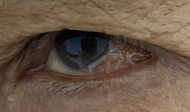 Gap con giun dai 14 cm khoi mat benh nhan 68 tuoi