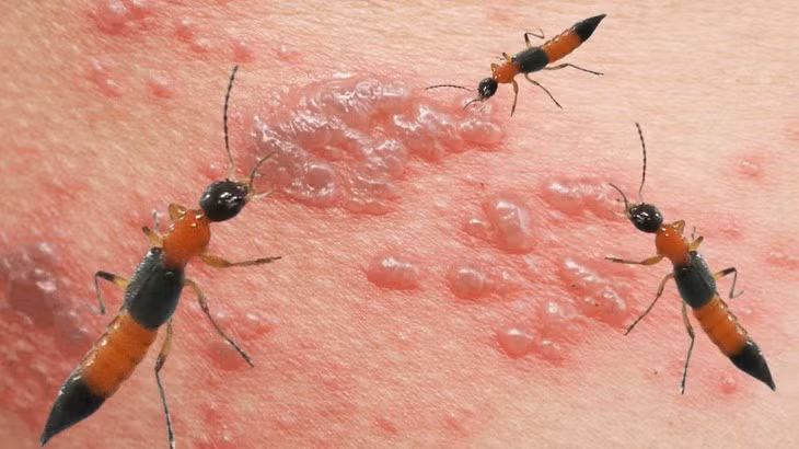 Cách đơn giản xử lý độc khi bị kiến ba khoang cắn - Hình 3 Cach don gian xu ly doc khi bi kien ba khoang can-Hinh-3