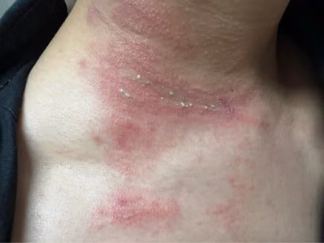 Cách đơn giản xử lý độc khi bị kiến ba khoang cắn Cach don gian xu ly doc khi bi kien ba khoang can