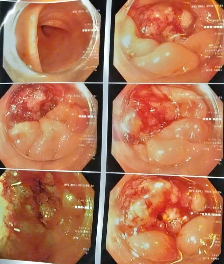 Tuong benh duong tieu hoa… bat ngo nhan ket qua ung thu-Hinh-2