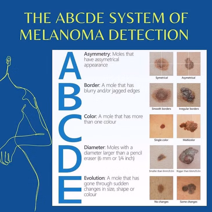 Ung thu da tu 1 not cham nho sam mau, bac si canh bao