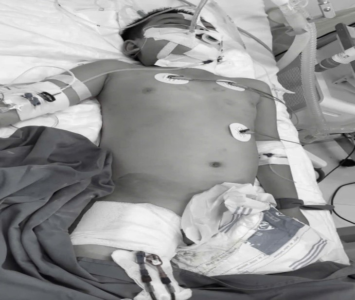 Cuu song benh nhi sot xuat huyet suy tang nang