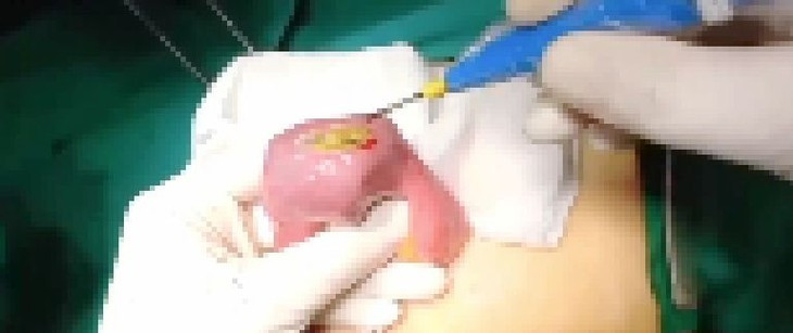 Nu benh nhan tac ruot do thoi quen nhai khong ky