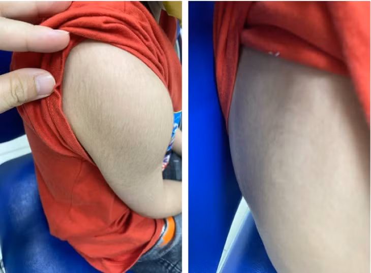 Suy tuyen thuong than do tu y dung “thuoc dong y tang can“