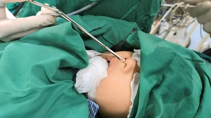 Hiem gap, be trai 4 tuoi co rang moc o mui-Hinh-2