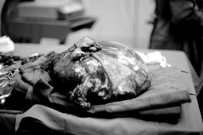 Cat khoi u xo tu cung nang 7,25kg cho benh nhan 52 tuoi-Hinh-2