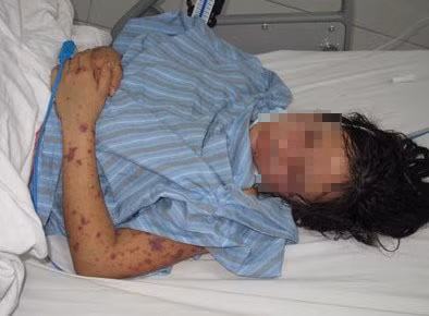 Cach ly khan cap co gai mac viem nao mo cau o Ha Noi