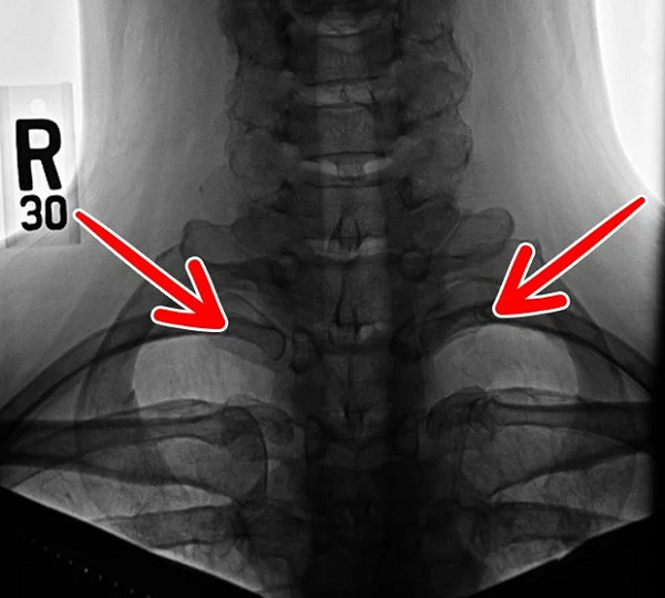 Khoảng 1% dân số thế giới có nhiều xương sườn hơn bình thường, kéo cả lên khu vực gần cổ. Theo Thuyết tiến hóa thì đây có thể là những gì còn sót lại từ thời kỳ khủng long lận, nhưng giờ thì chẳng còn tác dụng gì ngoài việc khiến chúng ta căng thẳng hơn và dễ gây bệnh về thần kinh.