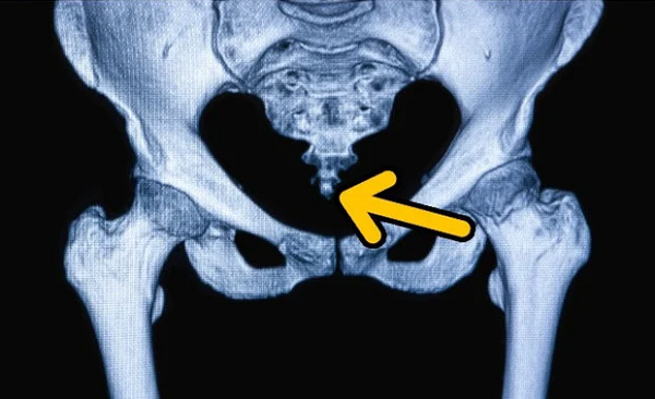 Nhiều người cho rằng phần trọng lực của chúng ta đi dọc xuống xương sống, từ đó không cần một phần phụ khác để cân bằng trọng lượng khá lớn từ phần đầu. Thế nên việc có phẫu thuật cắt bỏ hoặc sinh ra mà không có xương cụt cũng không để lại hậu quả tiêu cực nào. Và trong tương lai, rất có thể xương cụt sẽ biến mất.