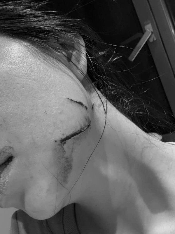 Hot TikToker cho biết, cô bị thương ở trong miệng và mặt, bác sĩ mất 3 tiếng mới khâu xong vết thương. Tuy bị thương nhưng Hằng Du Mục cũng thấy được hi vọng giành được quyền nuôi con.