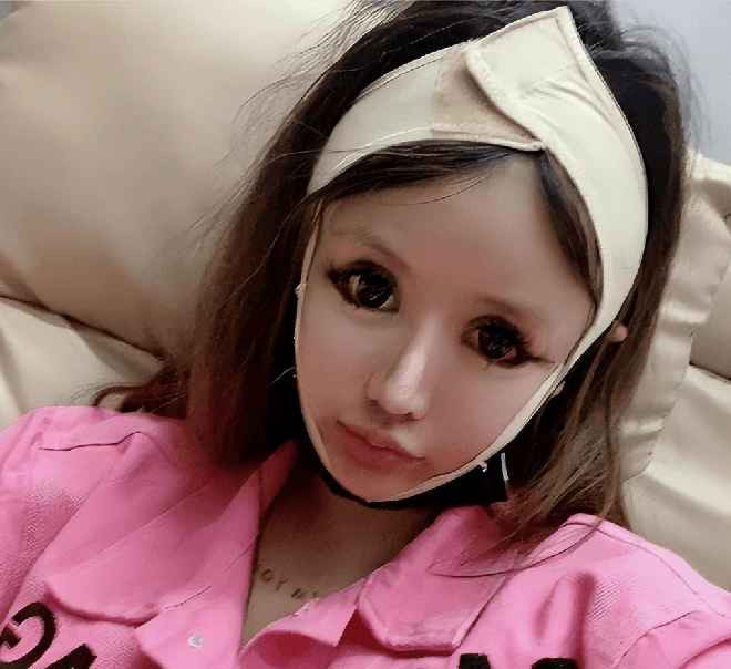 Vì "dao kéo" quá nhiều, gương mặt Zhou Chuna ngày càng biến dạng. Ví dụ, cô không thể nhắm mắt hoàn toàn khi đi ngủ do đã phẫu thuật mở khóe nhiều lần và thực hiện những ca chỉnh sửa phần mắt khác.