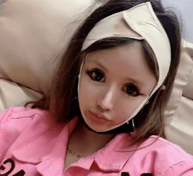 Vì "dao kéo" quá nhiều, gương mặt Zhou Chuna ngày càng biến dạng. Ví dụ, cô không thể nhắm mắt hoàn toàn khi đi ngủ do đã phẫu thuật mở khóe nhiều lần và thực hiện những ca chỉnh sửa phần mắt khác.