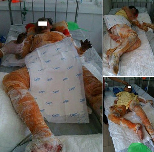 Cha hien da ghep cho con gai bi bong nang-Hinh-2