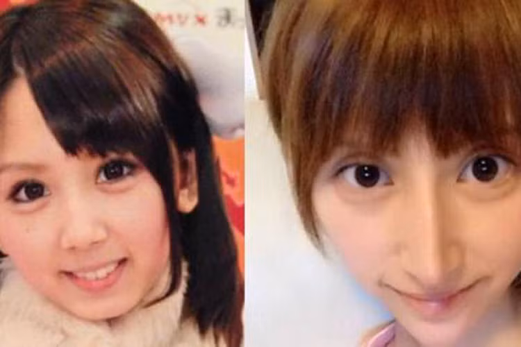 Nữ ca sĩ người Nhật Nanase Rina từ một cô gái xinh đẹp trở thành bất thường với chiếc mũi kì dị. Việc lạm dụng "dao kéo" khiến vùng mũi nhọn hoắt, bất cân đối với gương mặt. 