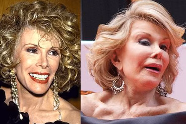 Người dẫn chương trình Joan Rivers trở thành một trong những “thảm họa dao kéo” sau khi làm một loạt phẫu thuật như nâng chân mày, cắt mí, phẫu thuật xương hàm, tiêm botox. Đặc biệt chiếc mũi nhọn hoắt, biến dạng khiến cư dân mạng chỉ trích việc mê muội “dao kéo” của Joan Rivers. 