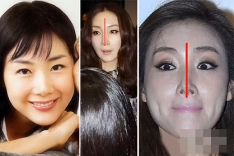 Người đẹp bị cư dân mạng Hàn soi nhiều nhất với nghi vấn “dao kéo” vùng mũi chính là Choi Ji Woo. 3 bức hình đặt cạnh nhau đã chỉ rõ phần mũi bị biến dạng, hai bên không đều nhau, khác hẳn với hình ảnh trong quá khứ (trái) 