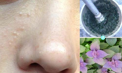 Bạn có thể trị mụn thịt ở nhà bằng lá tía tô.