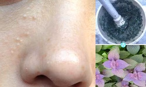 Bạn có thể trị mụn thịt ở nhà bằng lá tía tô.